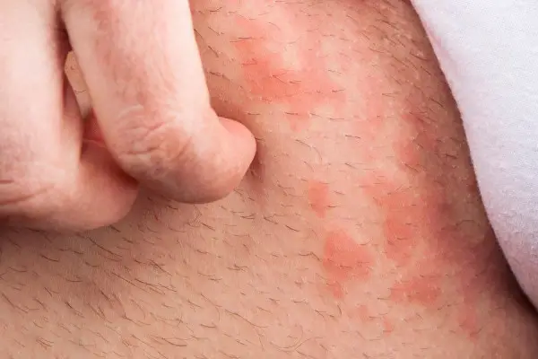 Reddened Skin - what may cause the symptom? - Skin Care