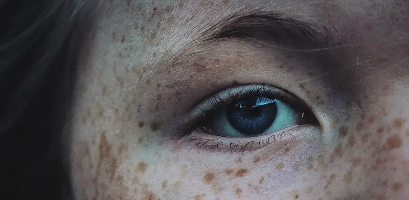 how to remove freckles from face