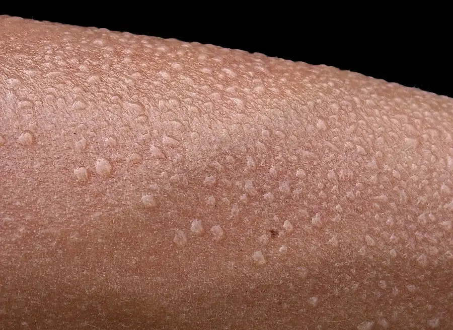 heat rash treatment close up