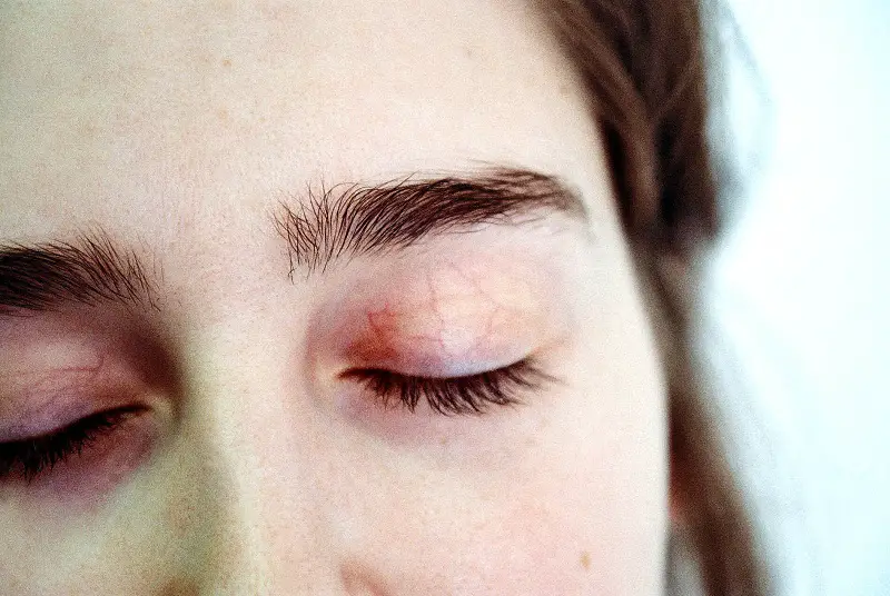 CO2 laser resurfacing results