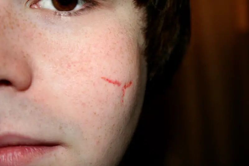 CO2 laser resurfacing effectiveness