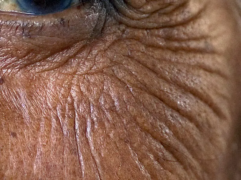 CO2 laser resurfacing methods