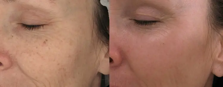 Fractional Laser Resurfacing