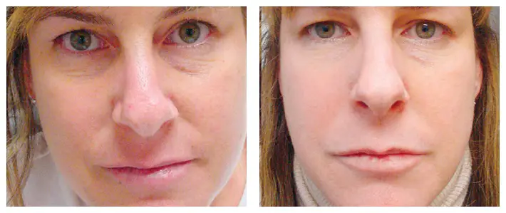 skin tightening laser treatment 