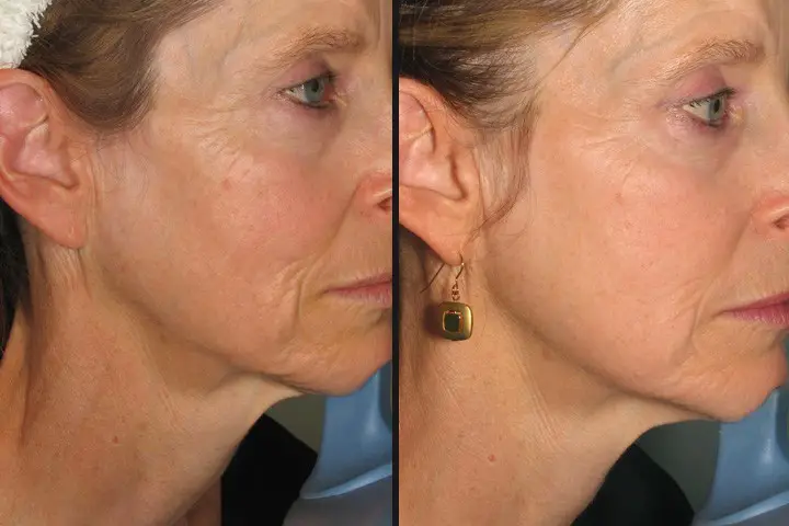 Skin Tightening Laser Treatment How It Works Pros And Cons 3280