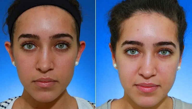 before and after a BHA peel