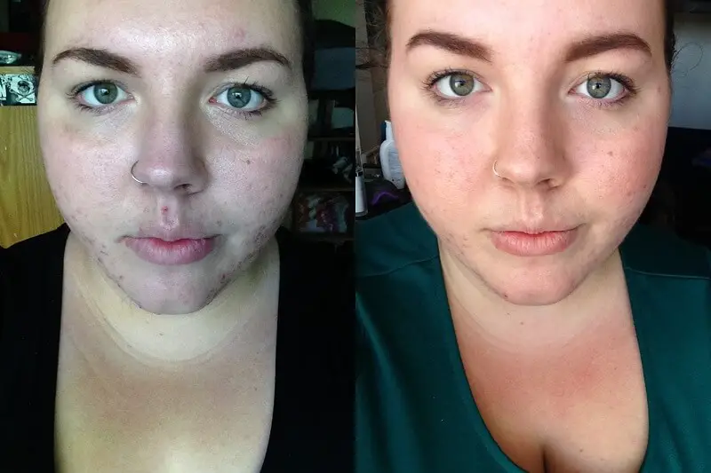 The effects of using a product with Azelaic Acid