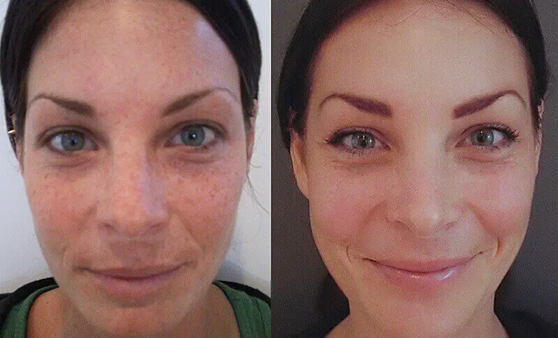 Getting rid of hyperpigmentation