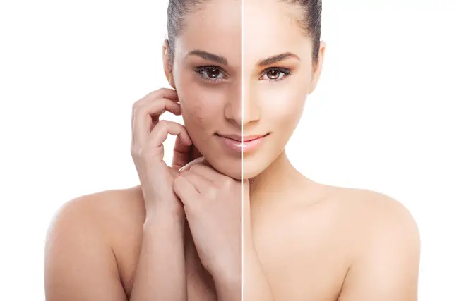 woman before and after using an skin peel