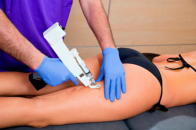 carboxytherapy for cellulite removal
