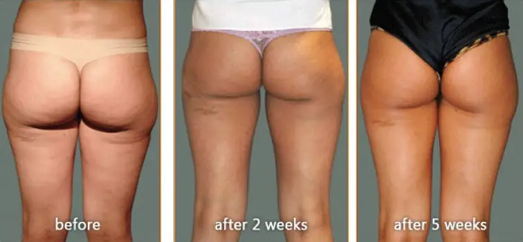 Carboxytherapy for Cellulite before and after
