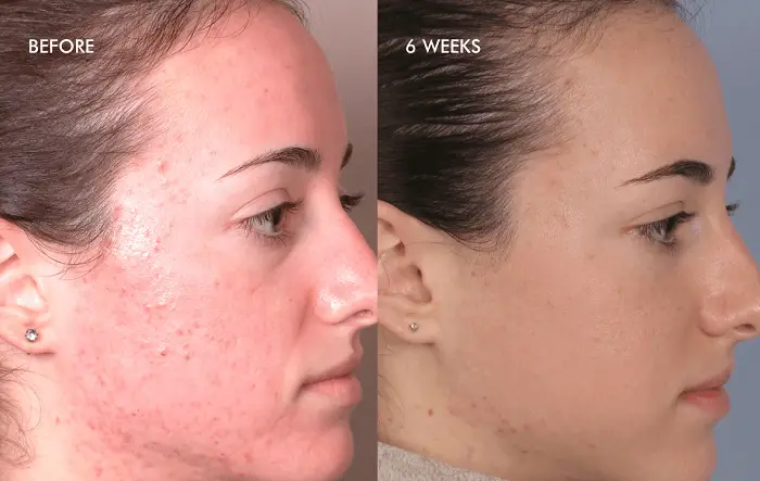 woman photographed before and after a silk peel