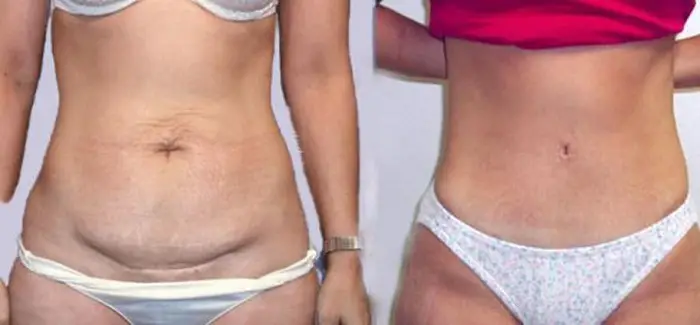 radio frequency skin tightening pictures
