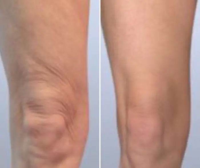 Ultrasound Treatment for Saggy Skin