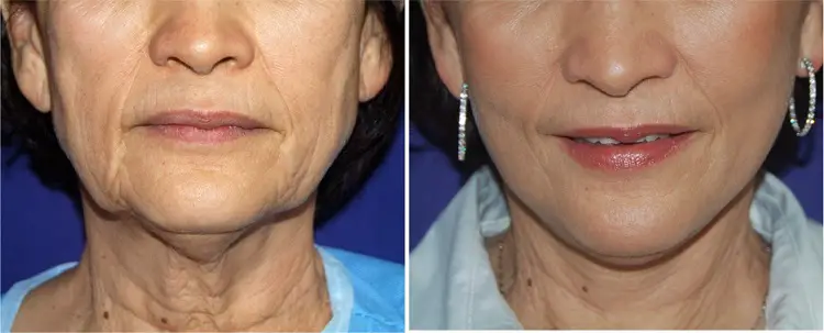 Rhytidectomy before and after