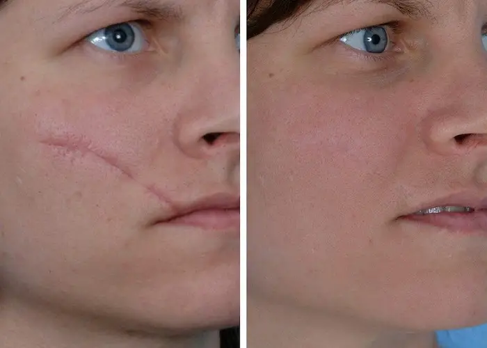 Laser scar removal before and after prictures