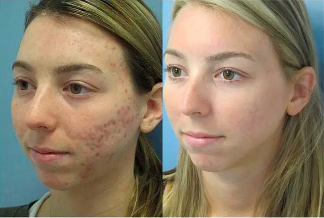Benefits of Laser Scar Removal