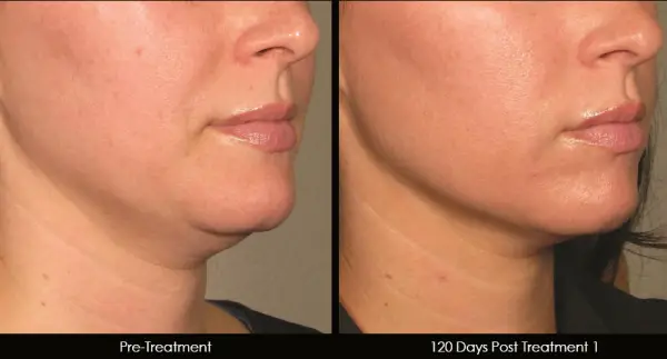 ultrasound skin tightening before and after