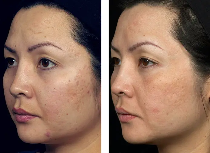 Non Ablative Laser Resurfacing