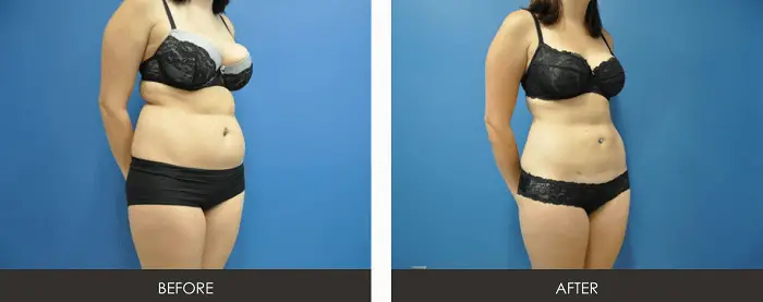 liposuction in the stomach area