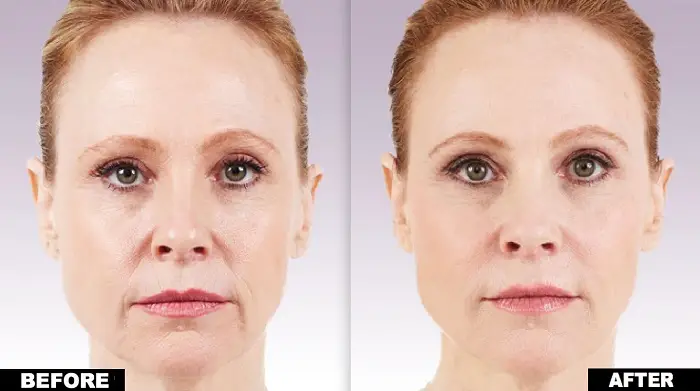 Dermal Filler effects