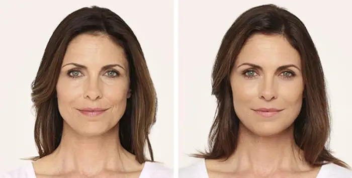 Radiesse before and after pictures