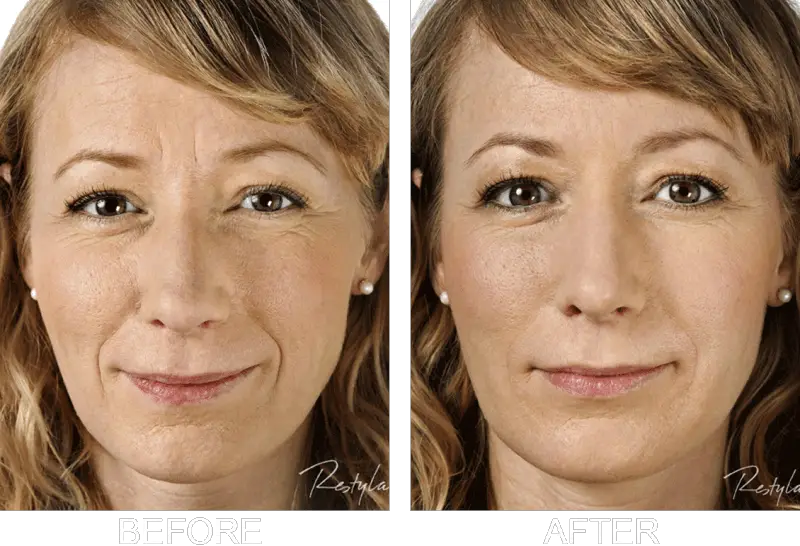 the effects of Restylane