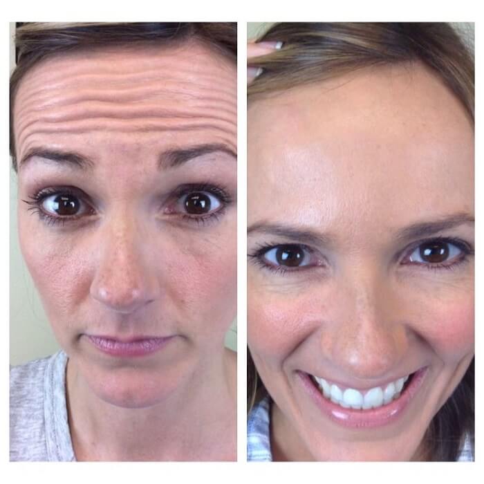 Botox effect on the forehead