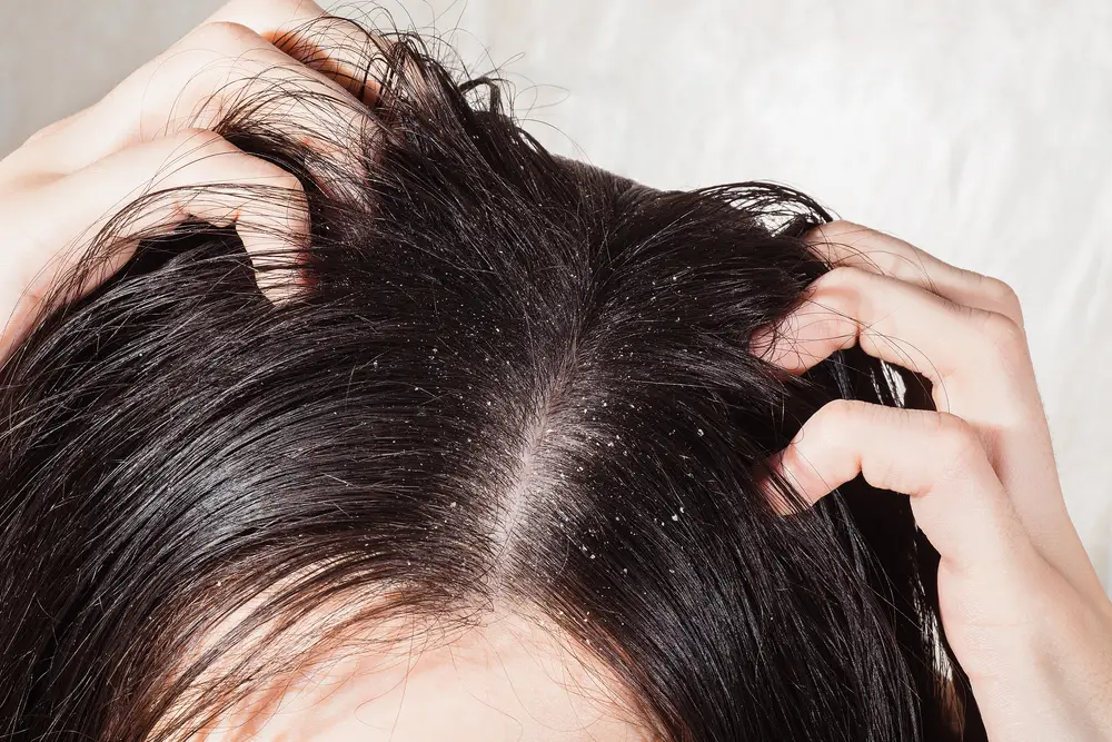 itchy scalp