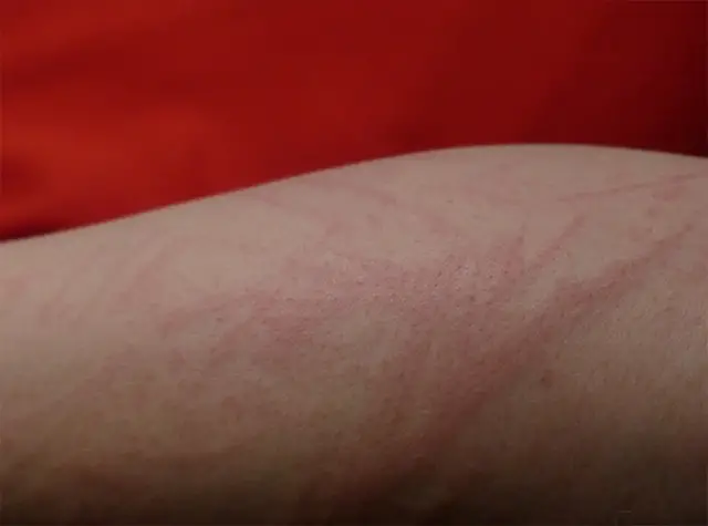 Skin irritation